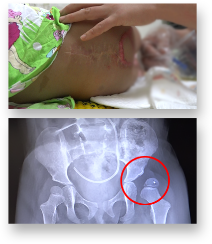 왼쪽 고관절이 탈구 되어있는 수연이의 골반 촬영 사진